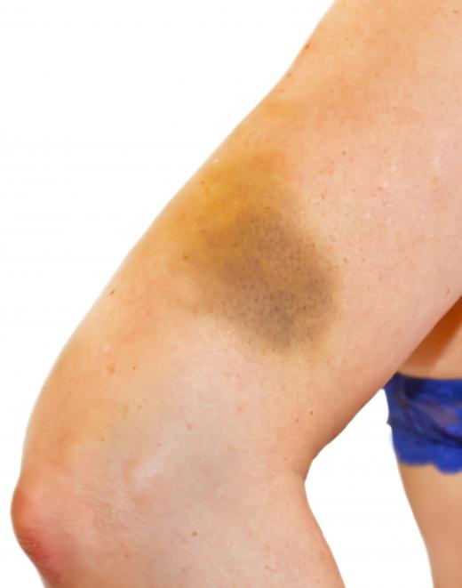 Bruises can also include many other colors in addition to black and blue.