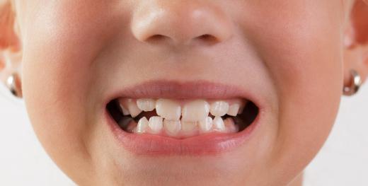 Children start to lose their baby teeth by about age 6.